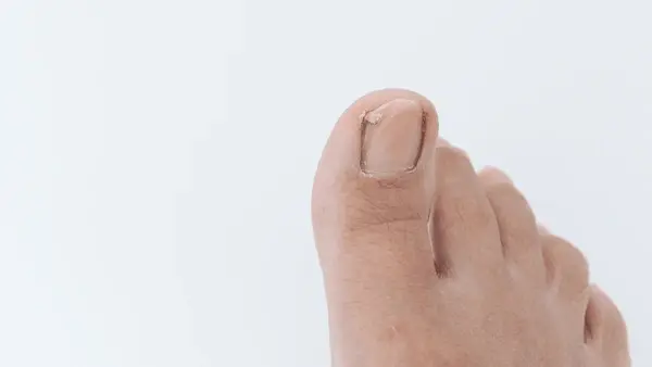 childrens ingrown toenail treatment in wilmington and inglewood, ca
