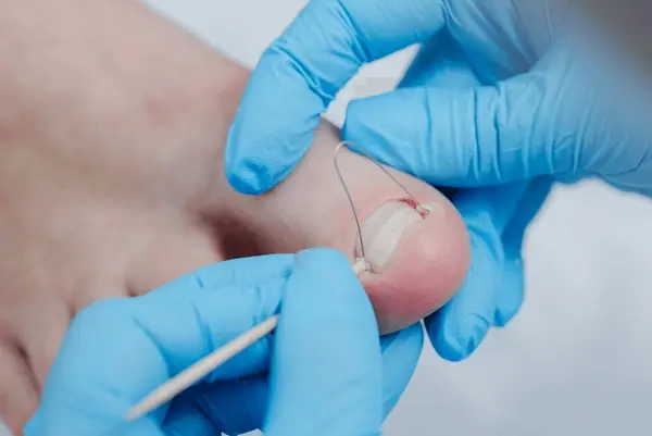 childrens ingrown toenail treatment near you